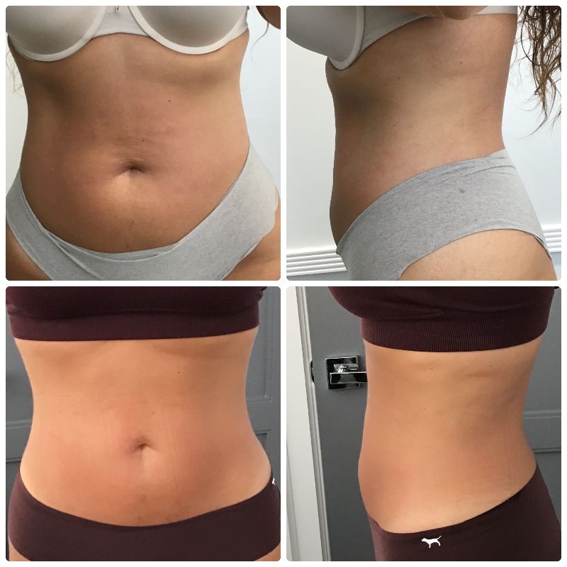 Painless Body Contouring Fort Lauderdale FL
